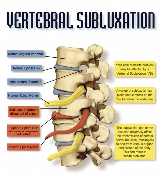 Vertebral Subluxation Chart